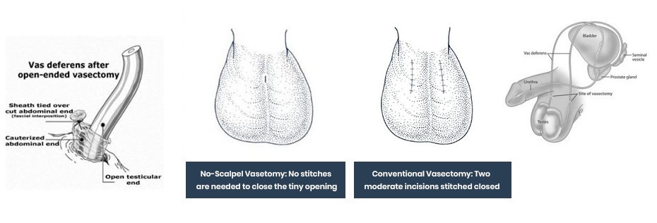 Conventional vasectomy is done by using a scalpel. 